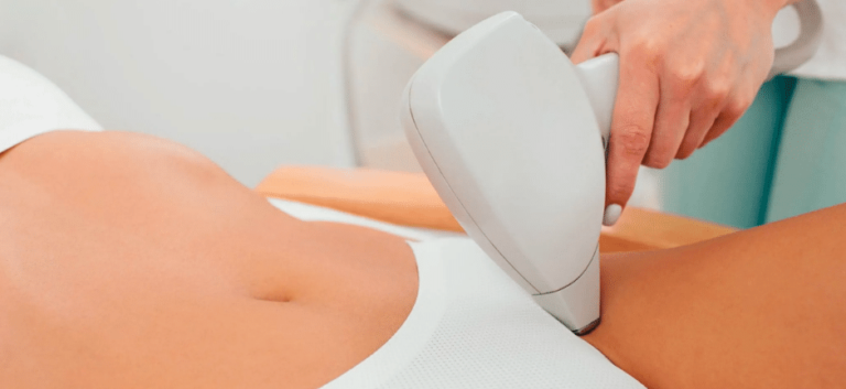 Brazilian laser hair removal process