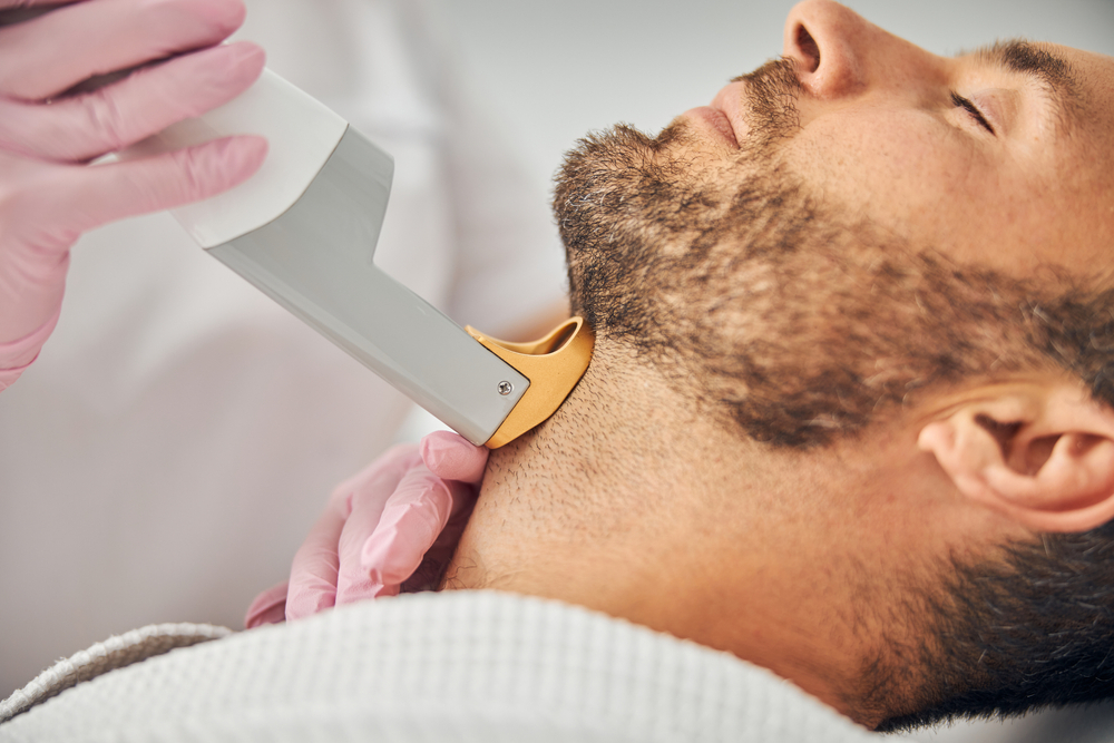 beard laser removal