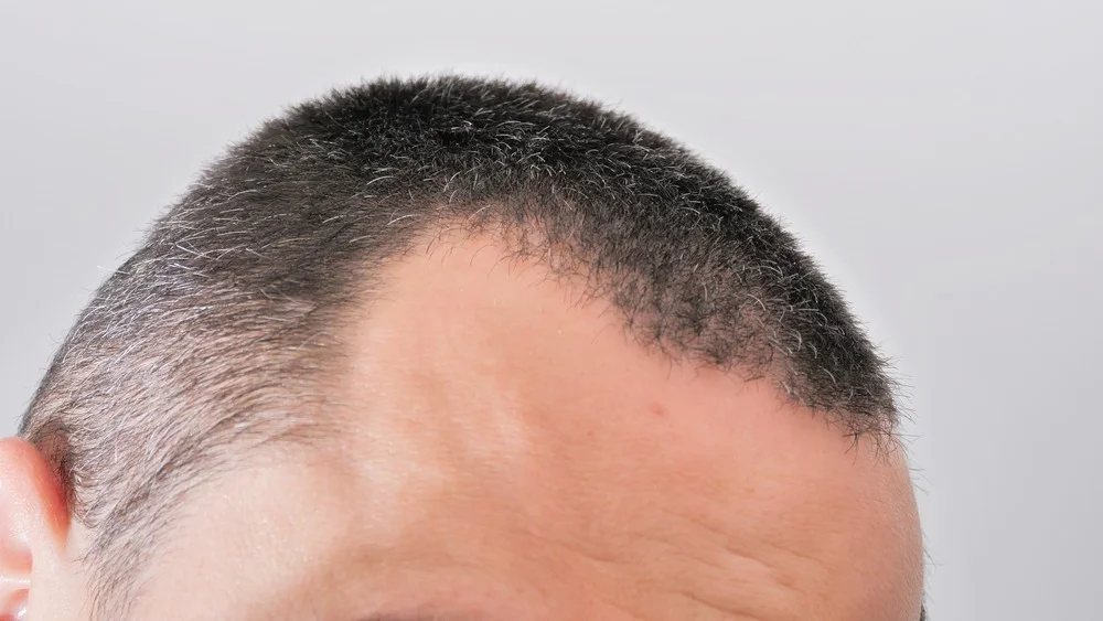 male hair transplant toronto