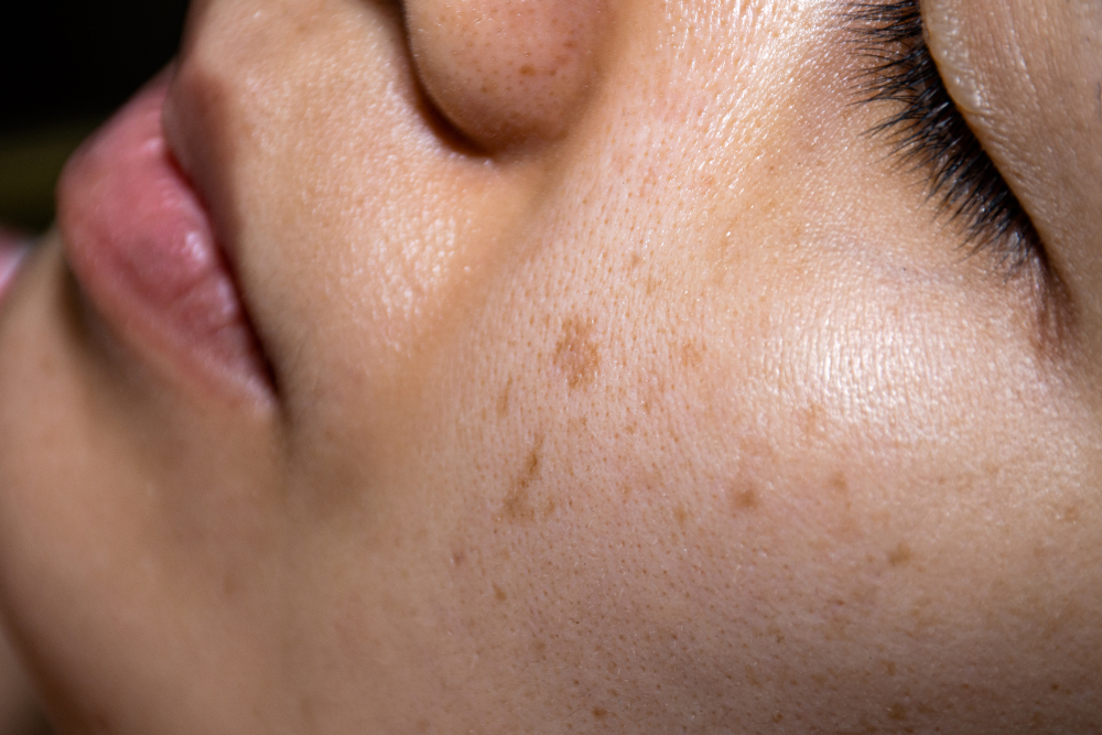 fraxel laser oakville