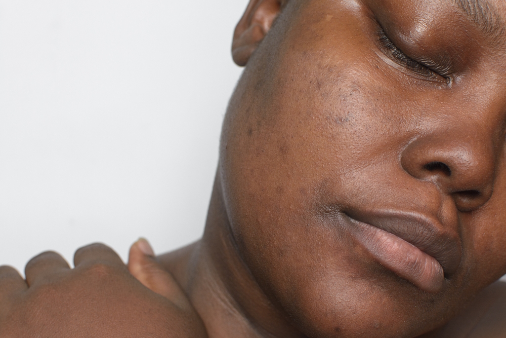 fraxel skin resurfacing
